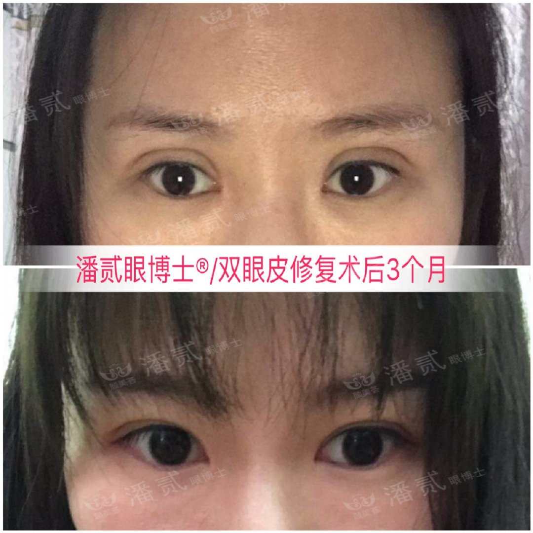 上海马大哈姑娘，稀里糊涂整了容，术后就一个字：丑