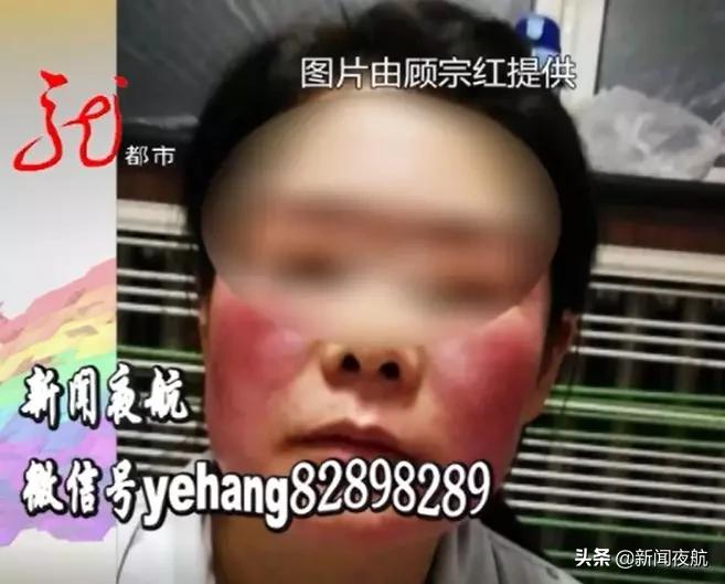 在车库里做液氮祛斑？斑点没去掉，脸都花了！这属于正常现象，还要继续治疗？液氮祛斑，是你想做就能做的吗