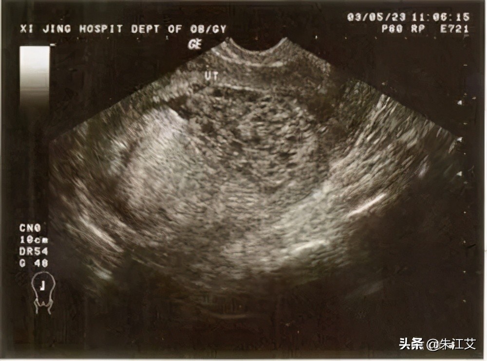 孕期出血怎么办专家教你正确应对,子宫异常出血和功能性出血的区别