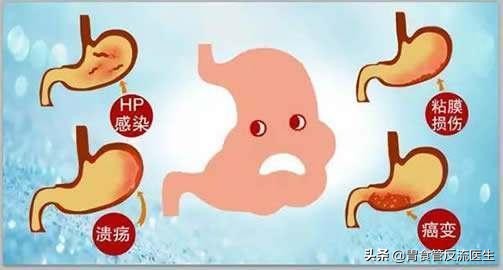 胃酸是怎么来的,为什么我感觉胃里是酸的,嘴巴也是酸的?