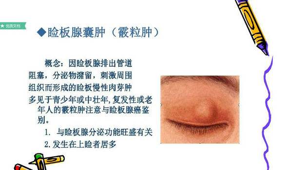 眼睛上长个小疙瘩怎么回事,小朋友眼睛里面长个小疙瘩