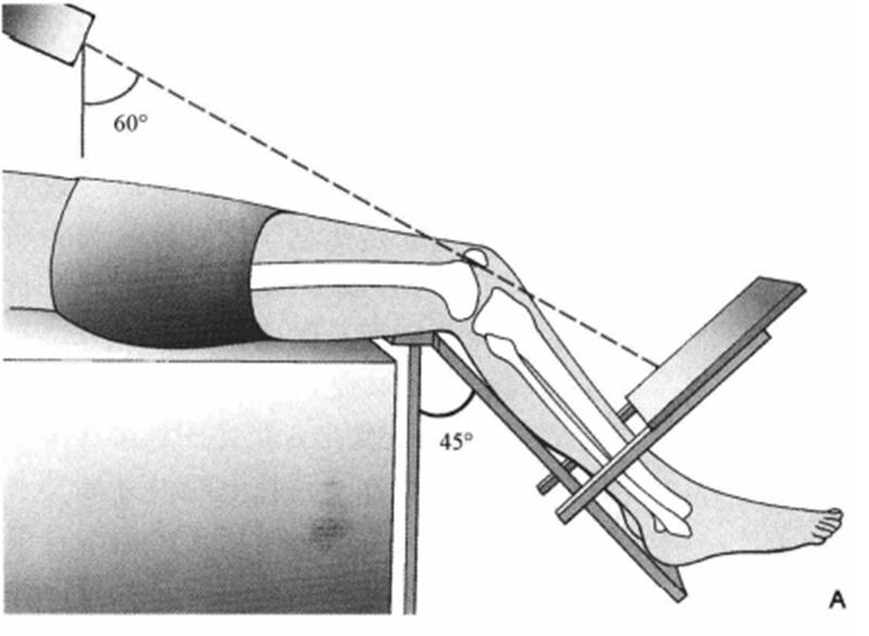 膝关节x线片可以查出啥,膝关节间隙x线测量方法