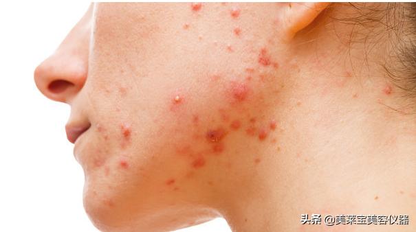 臭氧祛痘仪有用吗,青春痘怎么可以去