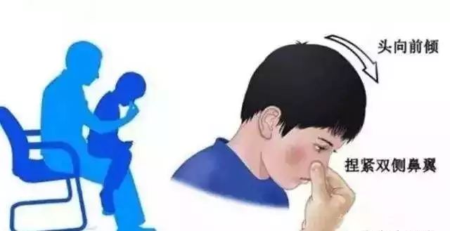 孩子流鼻血止不住怎么办啊,儿童流鼻血怎么办教你一招止血