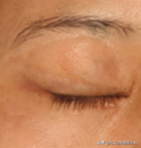 长了很多黑痣是什么原因,不规则的黑痣一定会癌变么