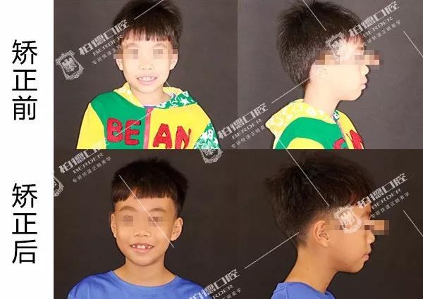 儿童牙齿早期干预矫正有几种,儿童牙齿早期矫正图片