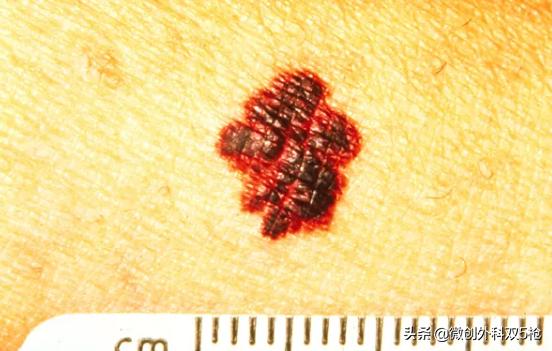 身上黑痔小心要了命！掌握ABCDE原则，教你肉眼判断黑色素瘤