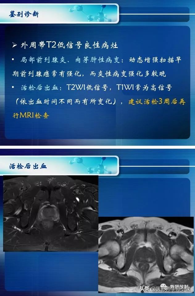 前列腺磁共振影像解剖,前列腺mri正常诊断报告模板