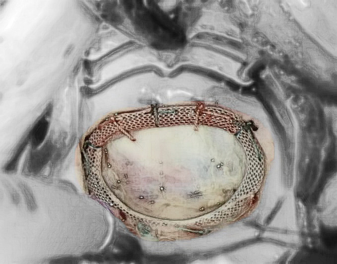 感染性心内膜炎不发热的原因,18岁女孩身上发热是怎么回事