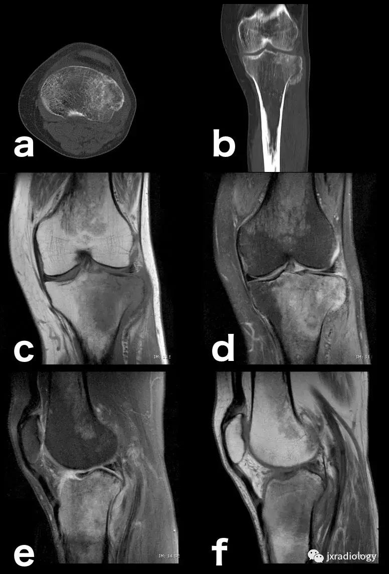 磁共振天天诊断骨髓水肿，但您知道原因吗？