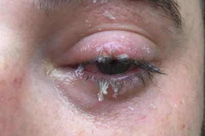 误把502胶水当作眼药水滴眼,502胶水怎么当眼药水