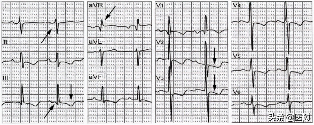 心电图t波改变是冠心病吗,心电图报告t波改变是冠心病吗