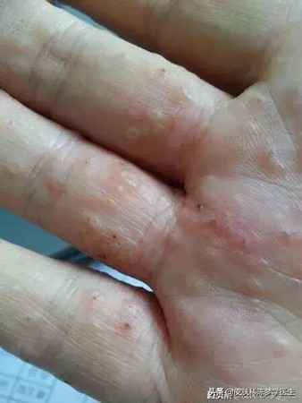 手上长了很多透明小水泡奇痒无比,天热手上起一片小水泡瘙痒