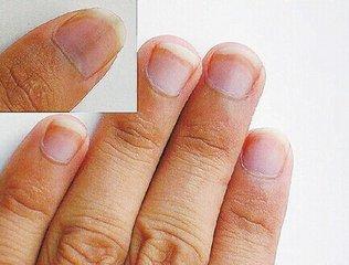 如何从手指甲上看病症,如何从指甲看疾病