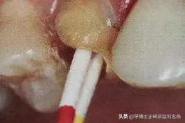 纤维桩修复费用,纤维桩修复全过程视频