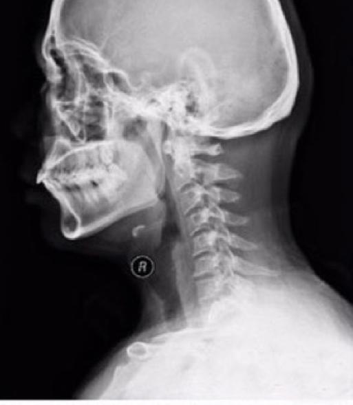 生理曲度变直是怎么回事,生理弧度消失呈反曲怎么回事