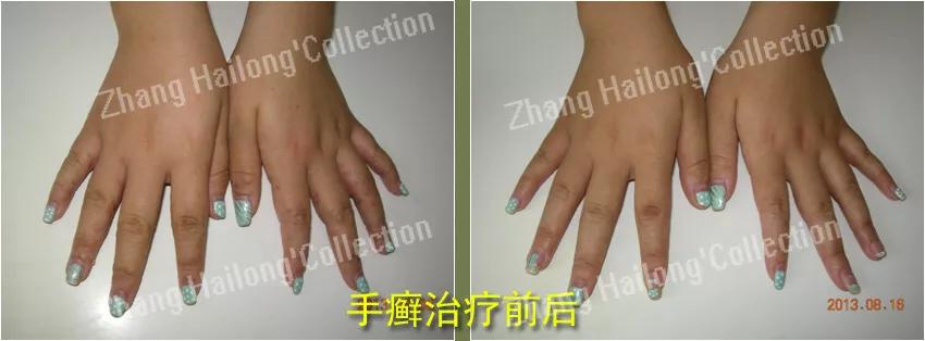 手特别干燥粗糙会是手癣吗,得了手癣指头皮肤变粗糙怎么办