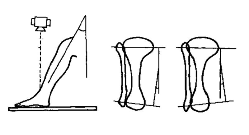 膝关节x线片可以查出啥,膝关节间隙x线测量方法