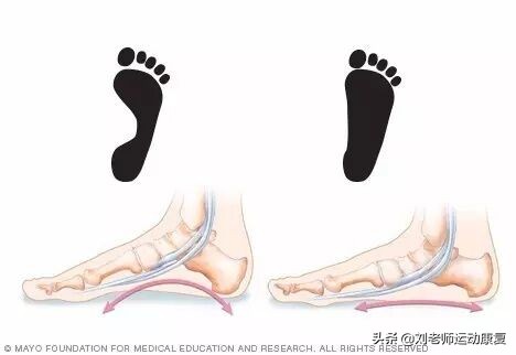 鞋垫减震缓冲改善扁平足,扁平足跑步选减震还是缓冲