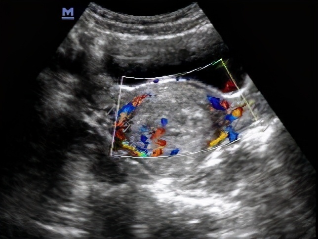 大腿酸痛后面查出子宫内膜癌,76岁老人小肚子长硬块