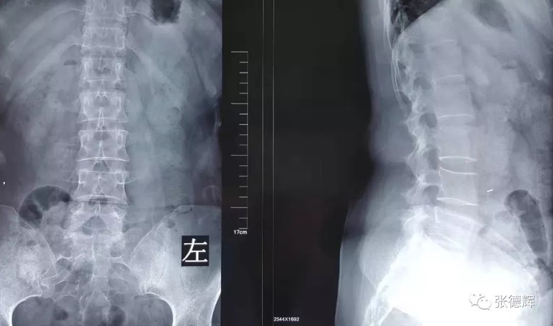 巨大腰间盘突出可以保守治疗吗,腰椎间盘突出不治疗越来越严重