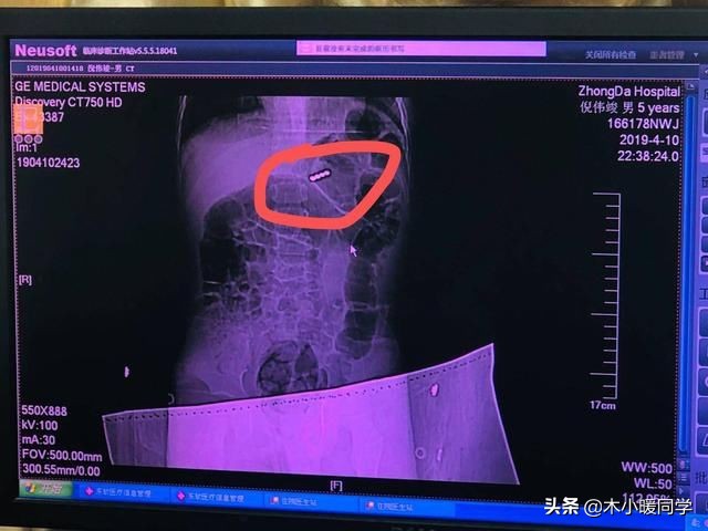 小孩误吞塑料异物怎么帮助排出来,宝宝误吞金属挂钩
