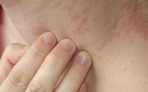 湿疹建议吃的食物,为什么不建议使用炉甘石治疗湿疹