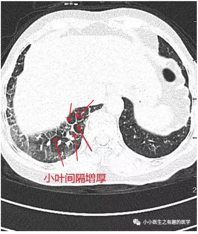 磨玻璃阴影怎么处理,磨玻璃阴影