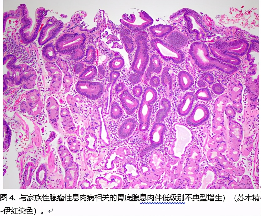 胃息肉可怕不,做胃镜查出胃里有息肉怎么办