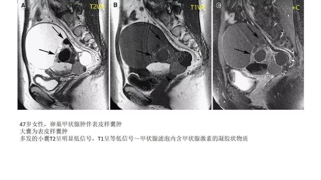卵巢原发肿瘤的分析思路