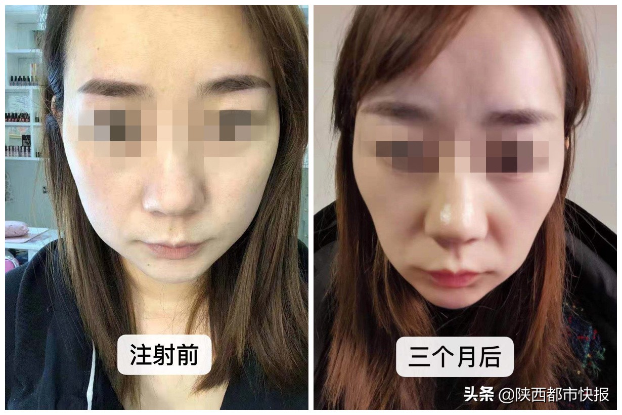 可怕！两女子6年交情“一针”终结！西安女孩瘦脸不成“脸塌了”