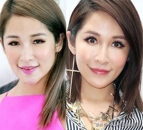 注射肉毒素脸部变化,肉毒素可以改变大小脸吗