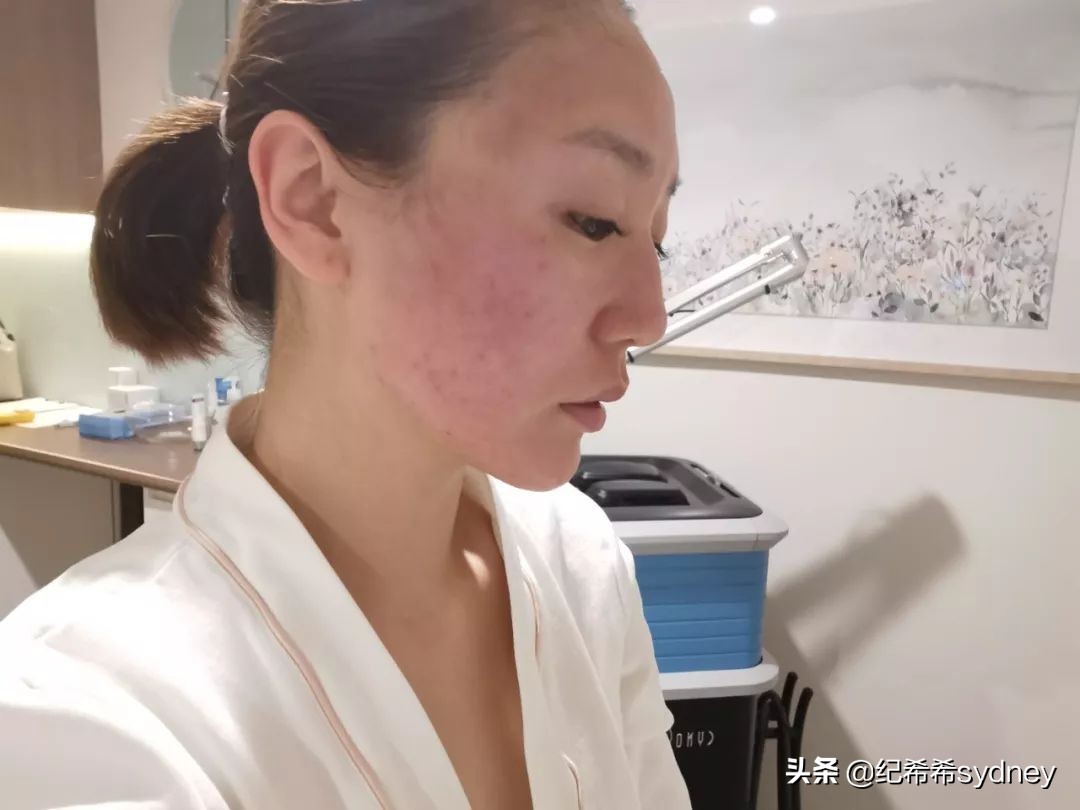 蜂巢皮秒祛斑一到七天变化图,蜂巢皮秒效果多久出来