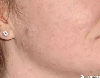 光子嫩肤帮你逆袭光滑细嫩状态,光子嫩肤让你拥有蛋壳般肌肤