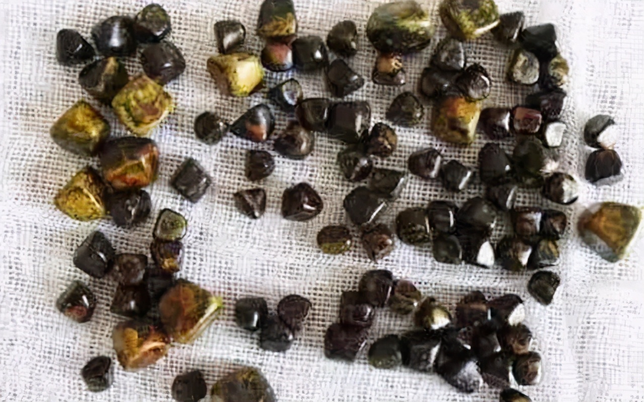 多次住院情况说明,胆结石反复发作怎么办有什么危害