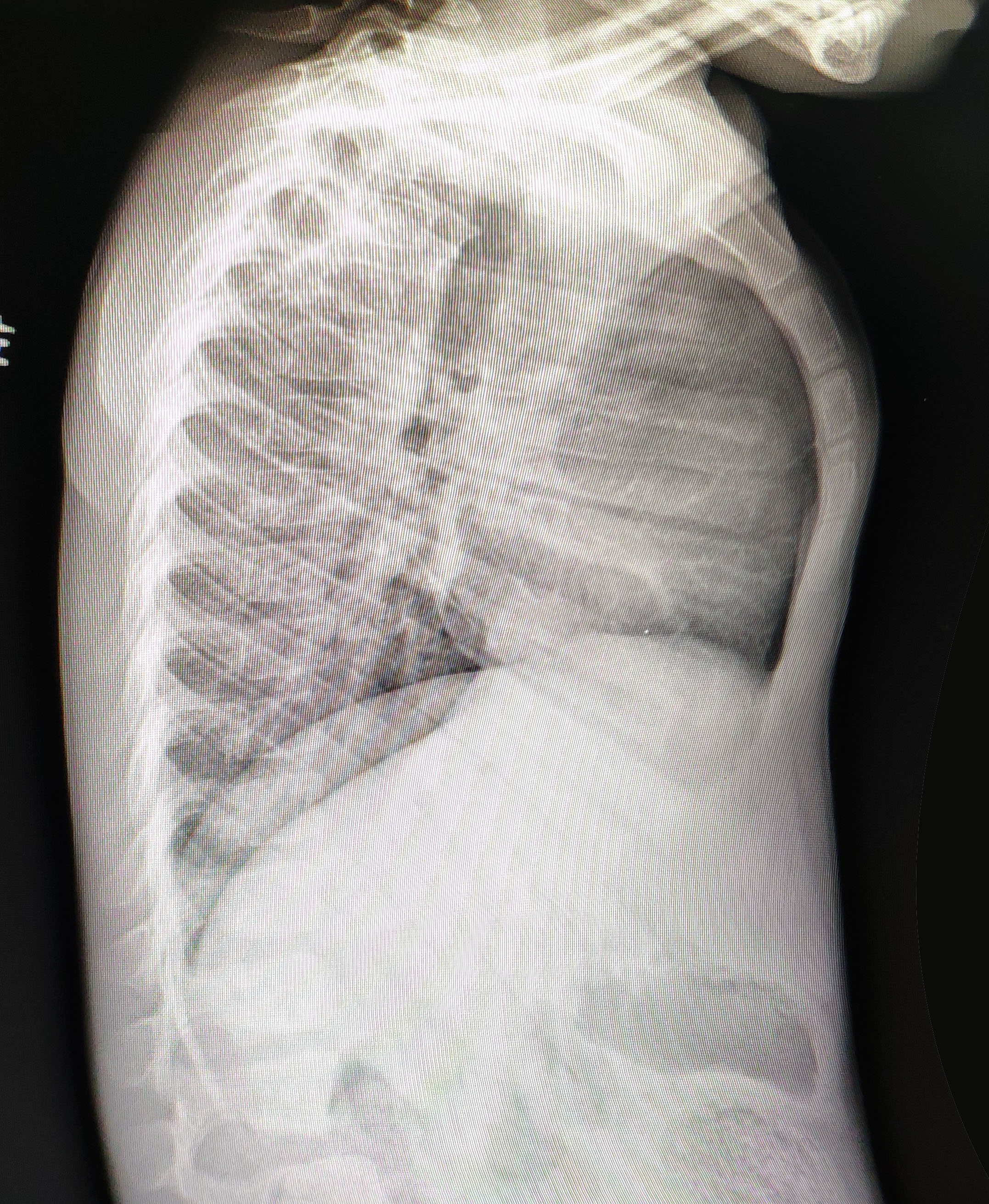 今天的鸡胸Wenlin手术：4岁