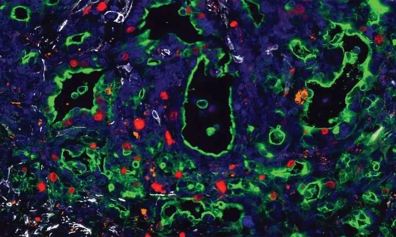 胰腺导管腺癌是最严重的癌症吗,为什么胰腺容易得癌