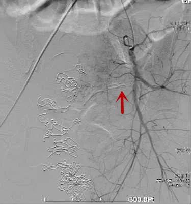 一产妇手术台上大出血死亡,一产妇大出血急需血小板去世