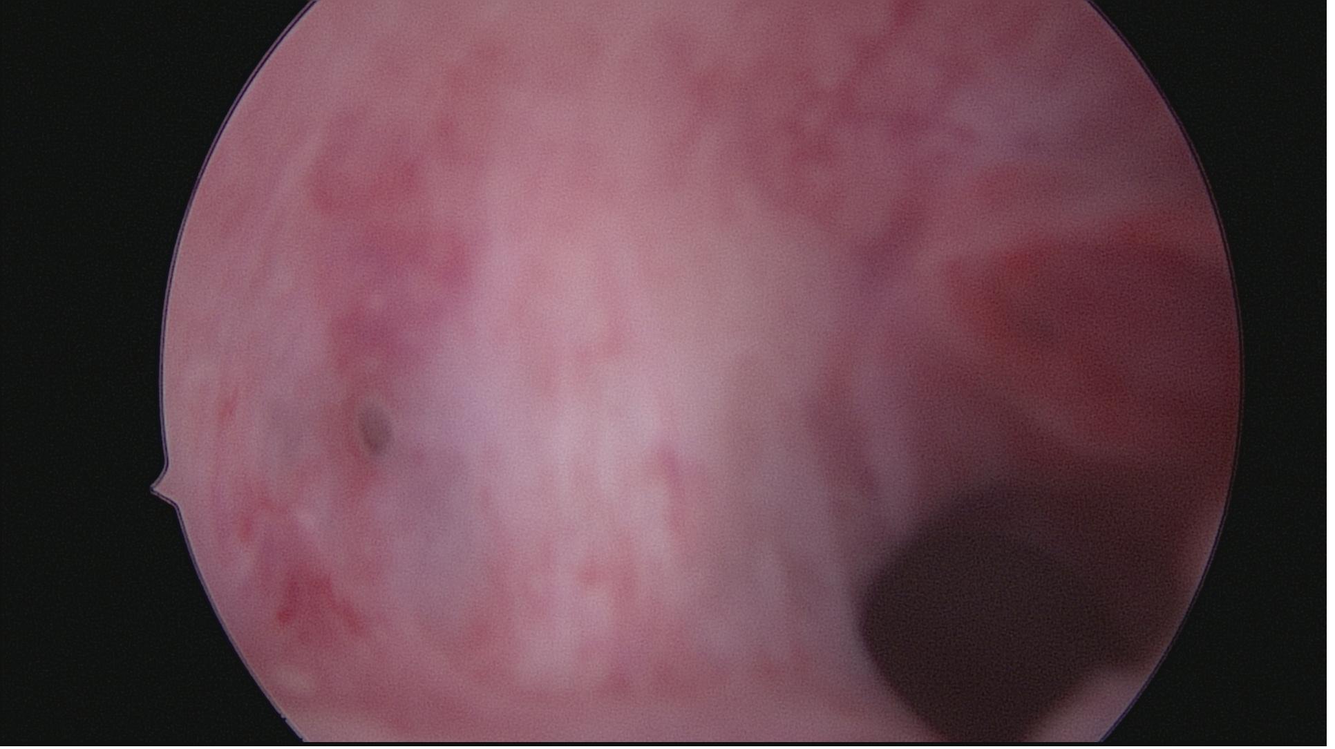 安徽宫腔镜手术专家排名,安徽省立宫腔镜哪个医生做的好