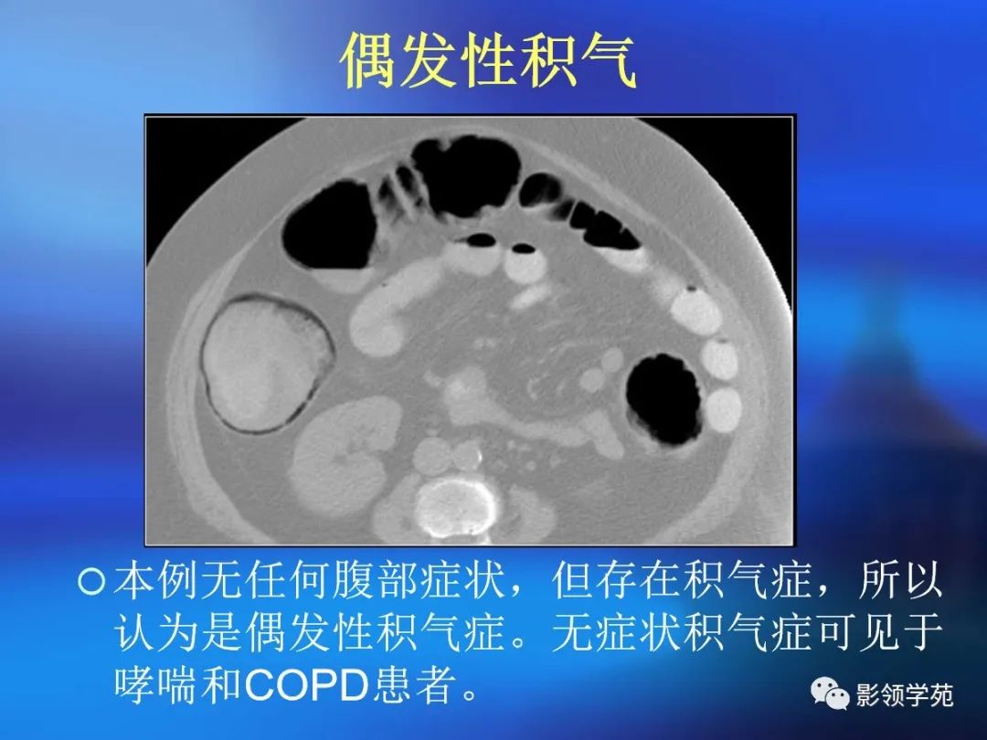 肠道内壁增厚,肠道扩张ct表现