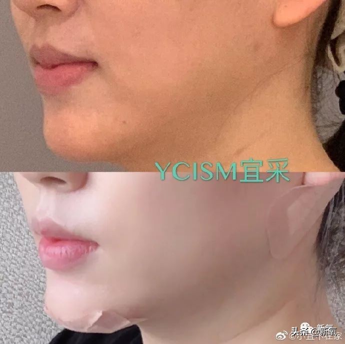 迷死氧亲身体验,我在日本吸掉了一桶脂肪和半张脸