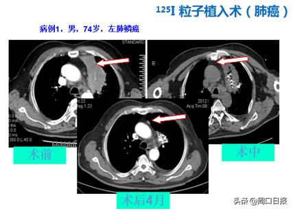 粒子植入治疗肿瘤和免疫疗法,肿瘤放射性粒子植入治疗技术