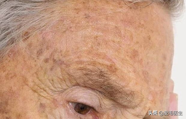 褐斑祛斑最有效方法,年轻人脸上长褐斑老年斑如何治疗