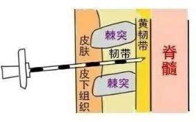 剖腹产你想知道的事,剖腹产后怎么知道刀口恢复情况
