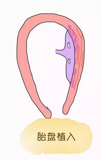 孕期发现胎盘前置是什么原因,引产前有什么症状