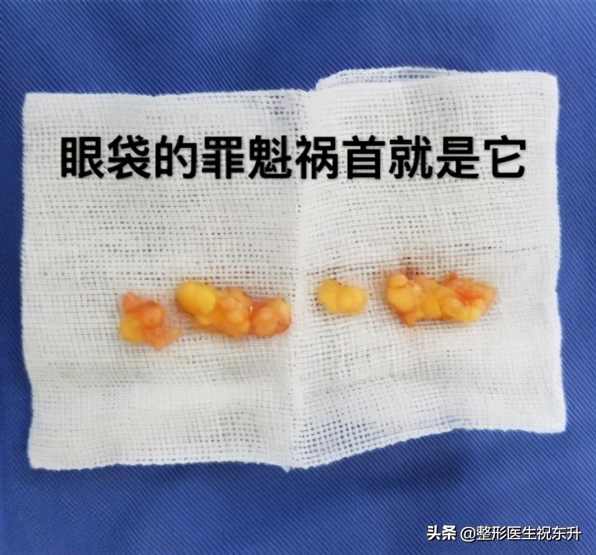 内切祛眼袋手术全过程,内切祛眼袋手术恢复记录