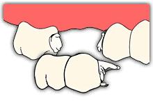 单颗牙缺失的修复方法,单颗牙缺失最好办法