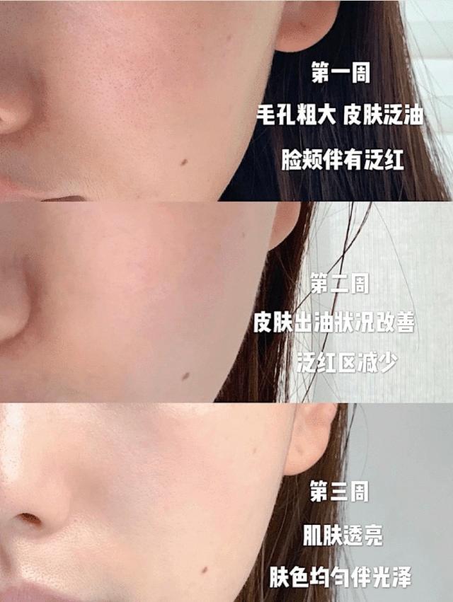 适合干皮痘痘肌的面霜海蓝之谜,海蓝之谜修护精华露适合干皮吗