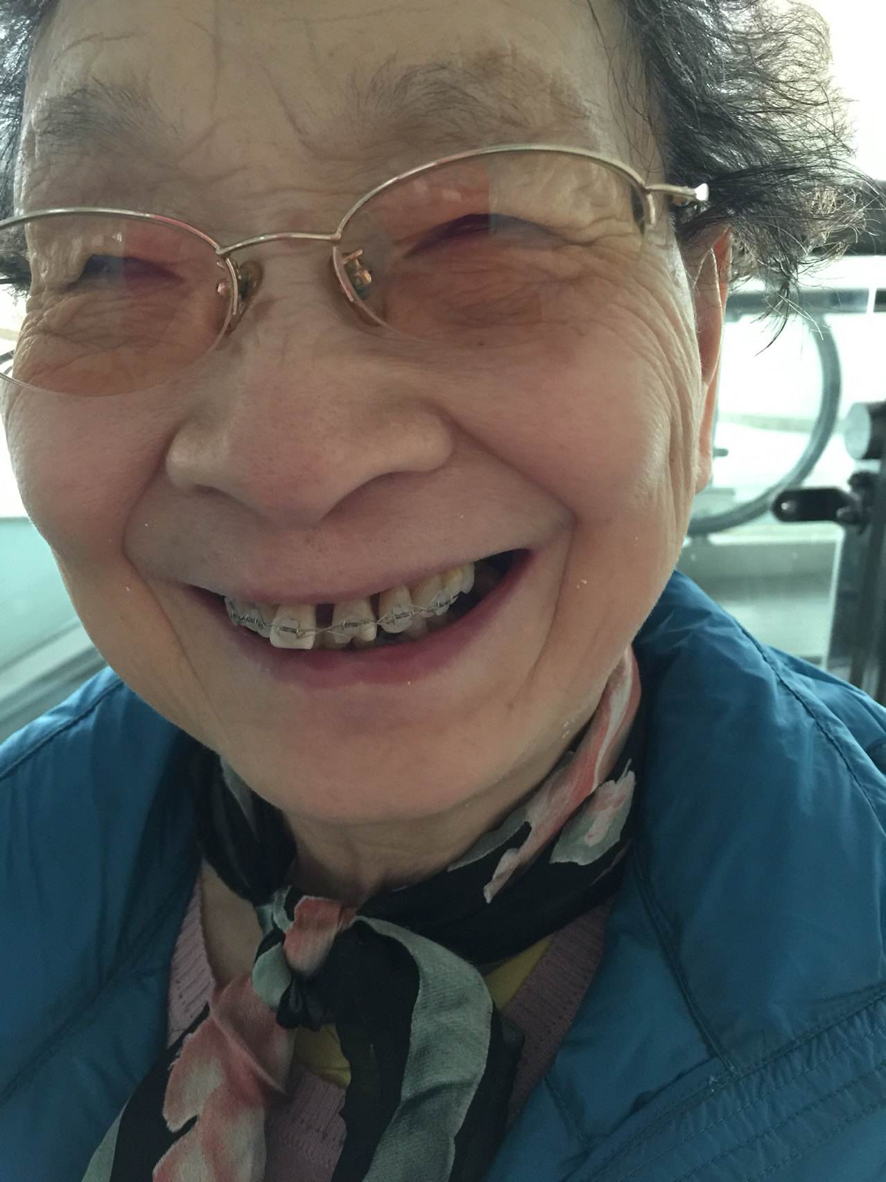 牙齐戴牙套可以改变脸型吗,戴牙套怎么才能不改变脸型