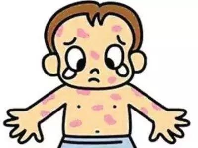 孩子喉咙痛低烧然后身上起疹子,小孩喉咙痛有小颗粒身上出疹